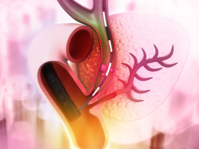 ERCP- Resized