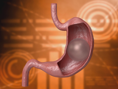 Gastric Balloon